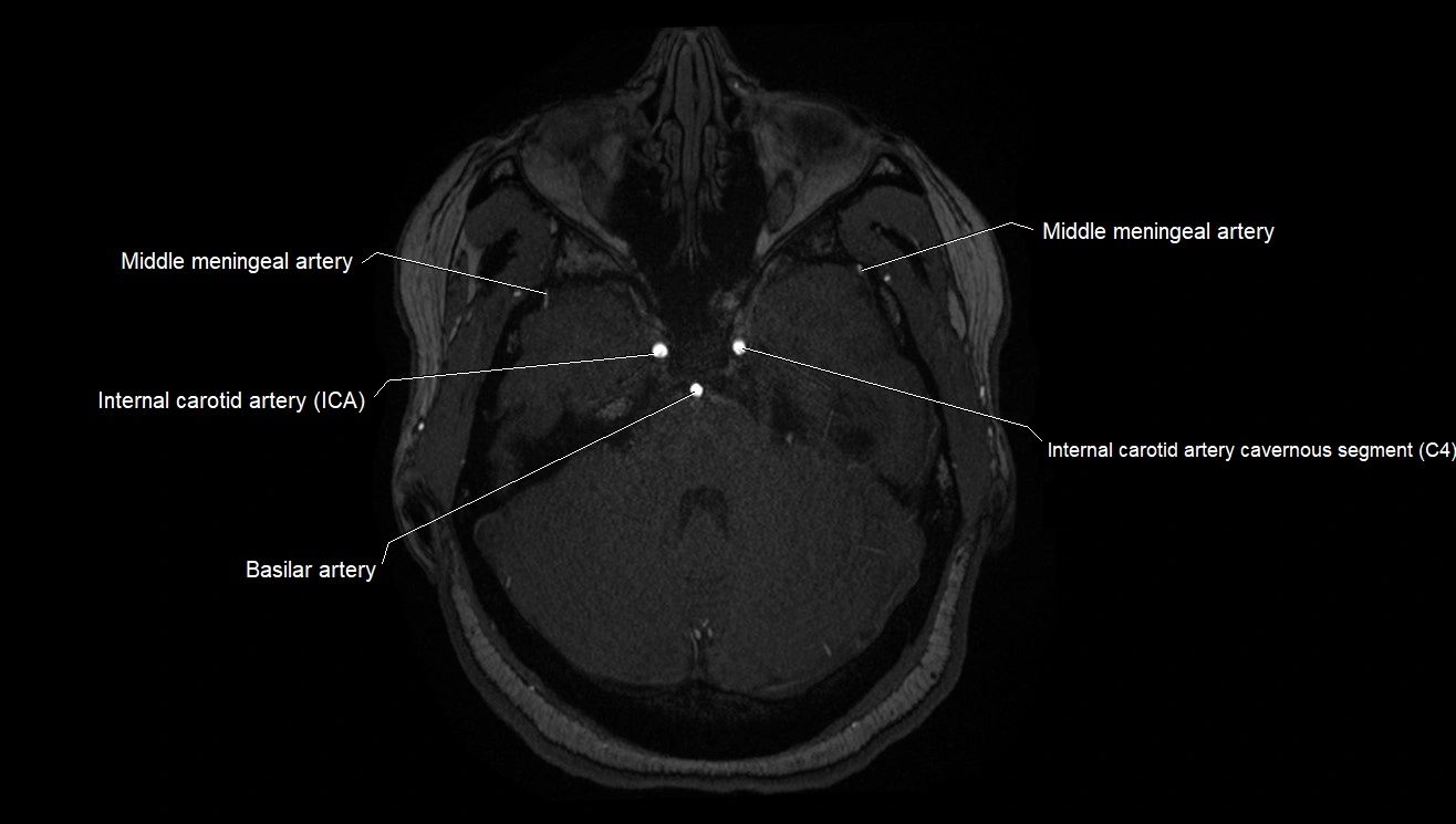 MRA brain (cerebral arteries) anatomy axial 3T image 6.webp